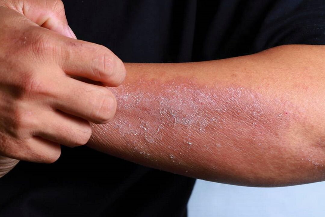 síntomas de psoriasis